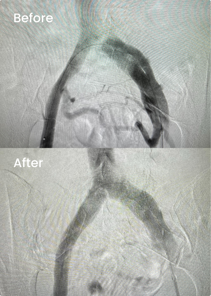 before-after-img Before and after venogram showing a narrowed vein reopened following venous stenting