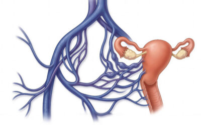 Pelvic Congestion Syndrome: Symptoms, Risks, and Treatment Options