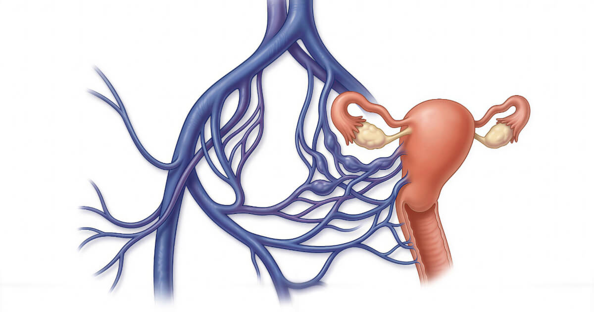 Pelvic-congestion-syndrome-medical-illustration-1 Pelvic Congestion Syndrome: Symptoms, Risks, and Treatment Options